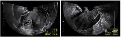 Case report: Robotically-treated spontaneous interstitial pregnancy on tubal stump